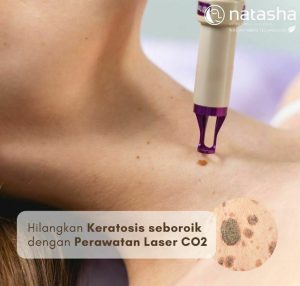 Daftar Harga Treatment Di Natasha Skincare Modern